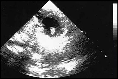 Case Report: Unusual Clinical Presentation of a Rare Cardiac Inflammatory Myofibroblastic Tumor in Children: The Differential Diagnosis With Pediatric Emergencies